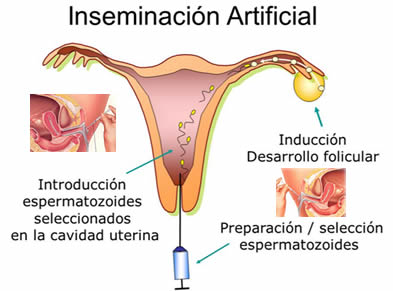 inseminación artificial 